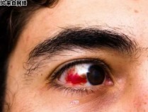 眼睛出血的原因与治疗方法