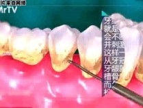 自己能不能清除牙垢和牙结石？