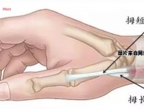 手腕腱鞘的解剖位置示意图在哪里？