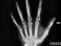手骨折康复需要多长时间 手骨折后期康复目标和措施