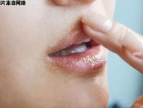 红霉素软膏可否用于治疗嘴唇干裂？