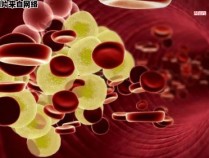 如何降低血液中过高的球蛋白含量