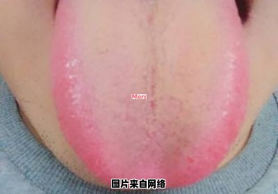 舌苔增厚的原因及治疗方法是什么?