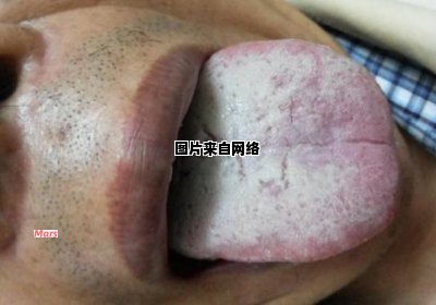 舌苔增厚的原因及治疗方法是什么?