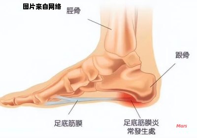 导致脚后跟痛的原因是什么？