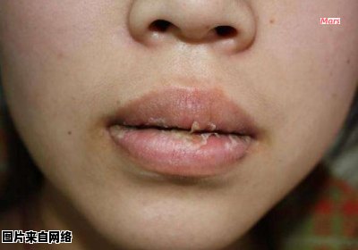 唇炎的快速治疗方法有哪些呢？