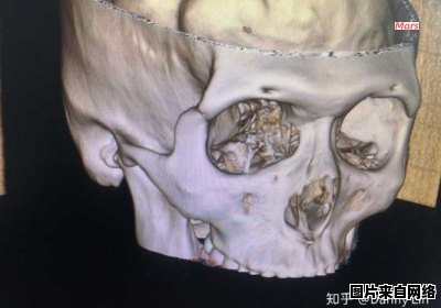 鼻骨骨折应采取何种处理方式？