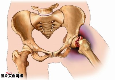 股骨骨折的症状都有哪些特征呢?