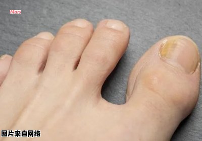 脚趾甲变黄的原因是什么呢？
