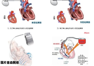 心脏起搏器使用时是否存在严重的副作用？